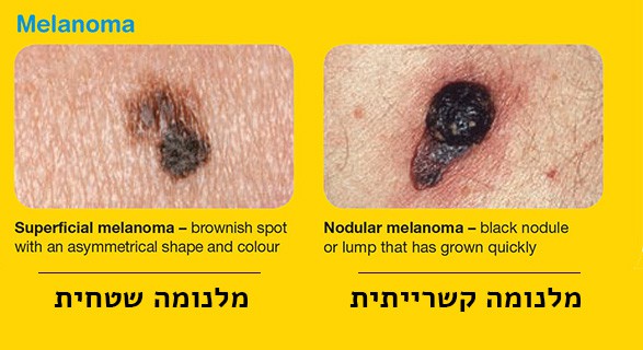 מלנומה קשרייתית ומלנומה שטחית | ספוט קליניק מרפאת עור ומרכז מומחים לרפואת עור