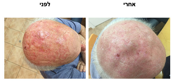 טיפול פוטודינמי · photodynamic therapy · ספוט קליניק מרכז מומחים לרפואת עור