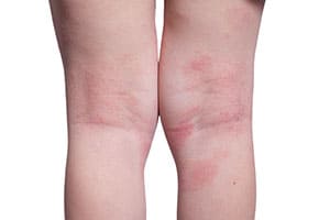 אטופיק דרמטיטיס / אסטמה של העור ברגליים | ספוט קליניק - מיטב המומחים לרפואת עור
