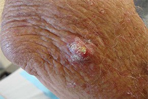 (Squamous Cell Carcinoma (SCC – סרטן העור של תאי הקשקש