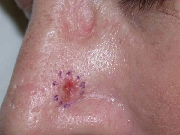 Basal Cell Carcinoma - BCC – סרטן העור של תאי הבסיס - פצע מדמם לא סדיר שאינו מחלים