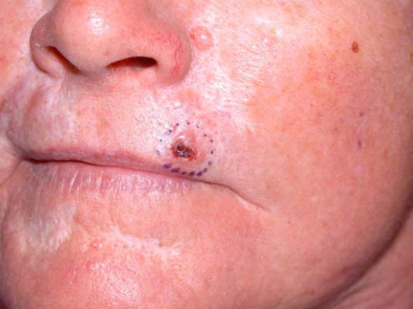 Basal Cell Carcinoma - BCC – סרטן העור של תאי הבסיס - קשרית מכוייבת לא סדירה שאינה מחלימה