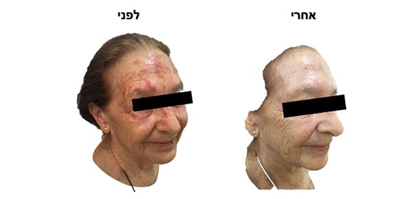 טיפול פוטודינמי · photodynamic therapy · ספוט קליניק מרכז מומחים לרפואת עור