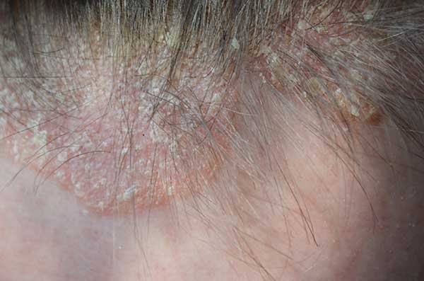 פסוריאזיס של הקרקפת · ספוט קליניק מרכז מומחים לרפואת עור