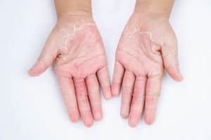 אלרגיה בעור • ספוט קליניק - מיטב המומחים לרפואת עור ולטיפול בתגובה אלרגית