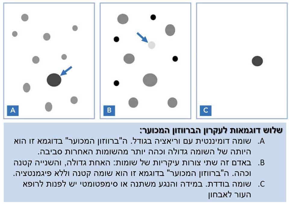 מלנומה ממאירה של העור | ספוט קליניק מרכז מומחים לרפואת עור