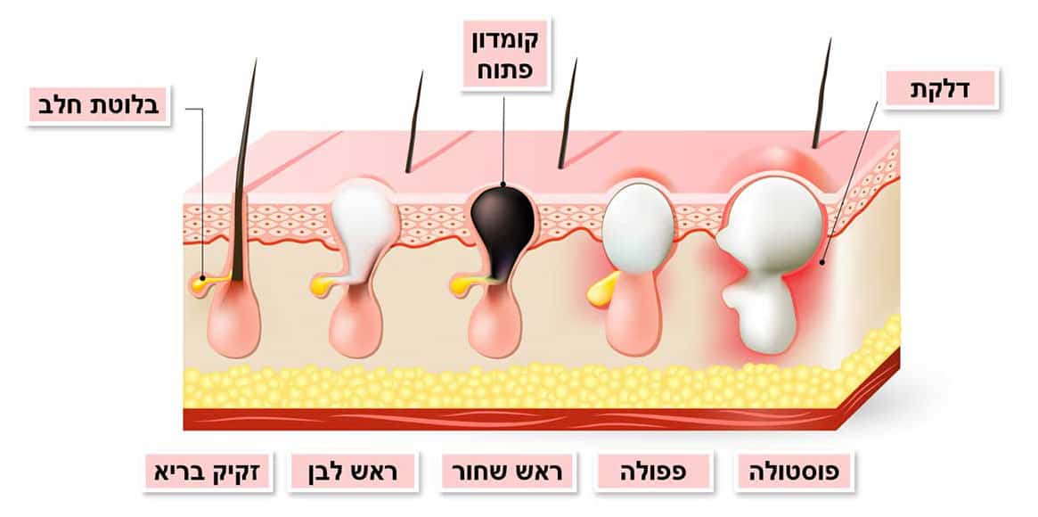 סוגים של נגעי אקנה