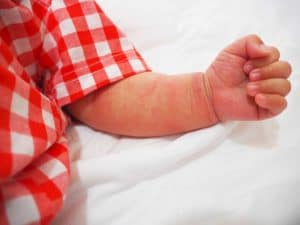 אטופיק דרמטיטיס / אסטמה של העור אצל תינוקות