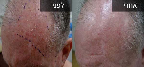 לפני ואחרי טיפול בקרנת עור אקטינית - נגעים אשר יכולים להתפתח לסרטן העור