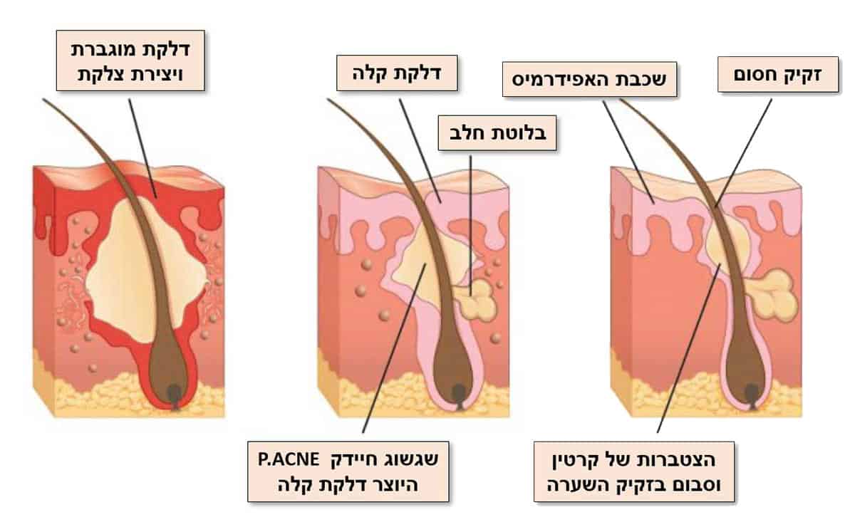 הגורמים לאקנה - ספוט קליניק מרפאת עור פרטית • טיפול באקנה