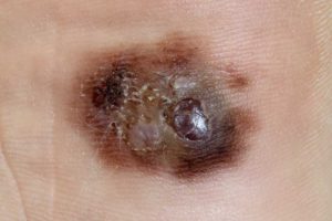 מלנומה קשרית (Nodular Melanoma)