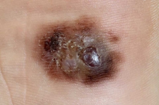 מלנומה קשרית (Nodular Melanoma) מלנומה קשרית (Nodular Melanoma)