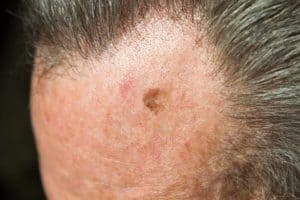 מלנומת נמש ממאירה (Lentigo Maligna Melanoma)