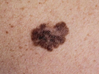 מלנומה שטחית (Superficial spreading melanoma) מלנומה שטחית (Superficial spreading melanoma)