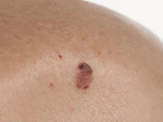 superficial spreading melanoma גב עליון superficial spreading melanoma גב עליון