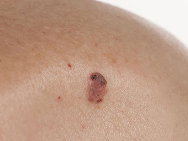 superficial spreading melanoma גב עליון