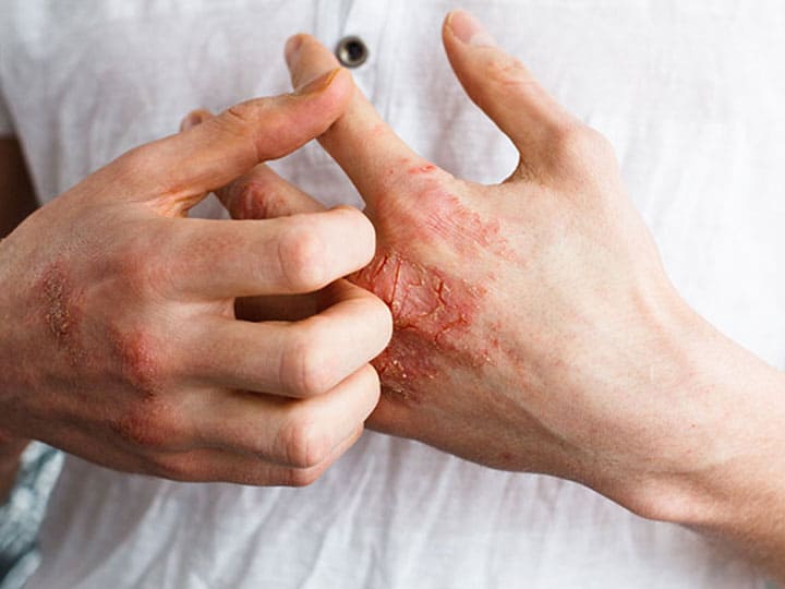 מחלות עור - דלקת עור ממגע