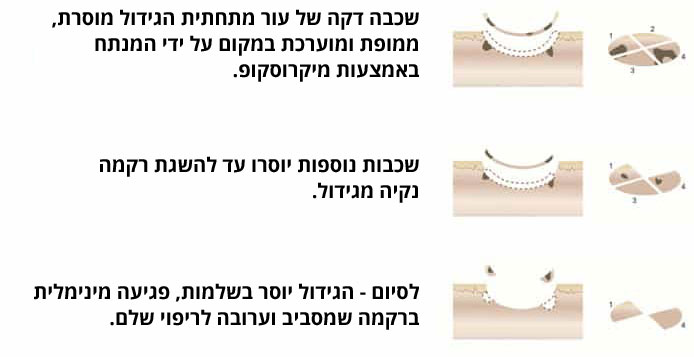 שלבי ניתוח מוז